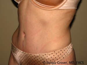 Tummy Tuck Before and After 38 | Sanjay Grover MD FACS