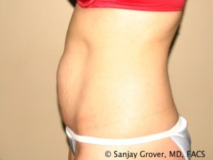 Tummy Tuck Before and After 38 | Sanjay Grover MD FACS