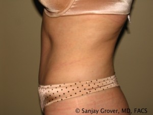 Tummy Tuck Before and After 38 | Sanjay Grover MD FACS