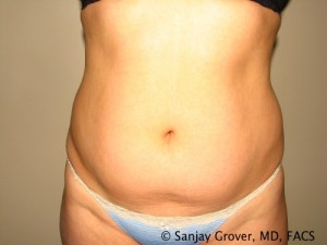 Tummy Tuck Before and After 06 | Sanjay Grover MD FACS