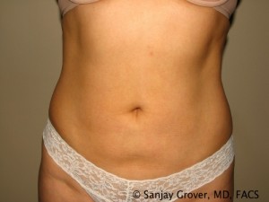 Tummy Tuck Before and After | Grover Aesthetics