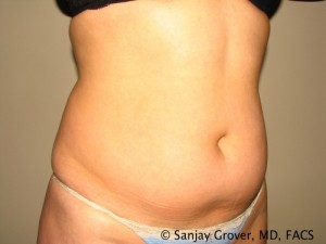 Tummy Tuck Before and After 39 | Sanjay Grover MD FACS