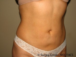 Tummy Tuck Before and After 39 | Sanjay Grover MD FACS