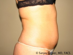 Tummy Tuck Before and After 39 | Sanjay Grover MD FACS