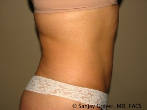 Tummy Tuck Before and After 39 | Sanjay Grover MD FACS