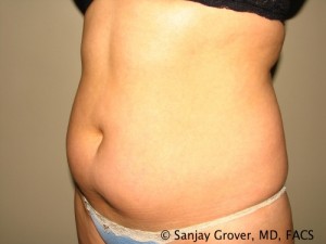 Tummy Tuck Before and After 39 | Sanjay Grover MD FACS