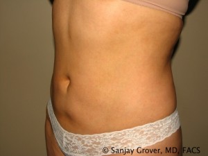 Tummy Tuck Before and After 39 | Sanjay Grover MD FACS