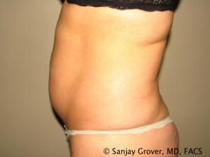 Tummy Tuck Before and After 39 | Sanjay Grover MD FACS