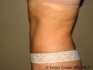 Tummy Tuck Before and After 39 | Sanjay Grover MD FACS