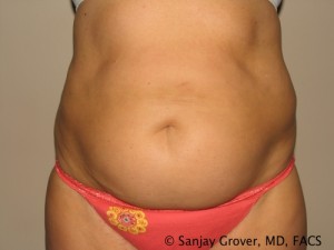 Tummy Tuck Before and After 44 | Sanjay Grover MD FACS