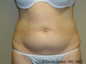 Tummy Tuck Before and After 77 | Sanjay Grover MD FACS