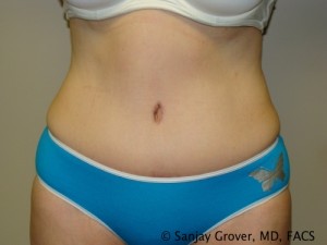 Tummy Tuck Before and After | Grover Aesthetics