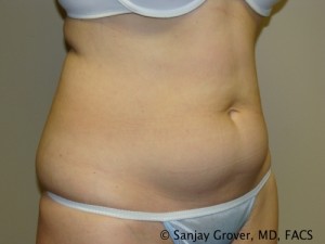 Tummy Tuck Before and After 40 | Grover Aesthetics