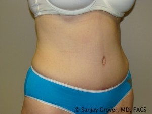 Tummy Tuck Before and After 40 | Grover Aesthetics