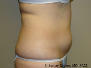 Tummy Tuck Before and After 40 | Grover Aesthetics