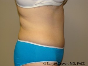 Tummy Tuck Before and After 40 | Grover Aesthetics