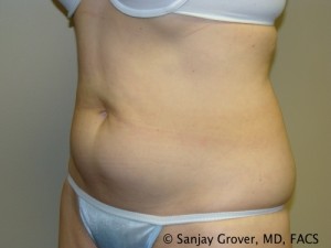 Tummy Tuck Before and After 40 | Grover Aesthetics