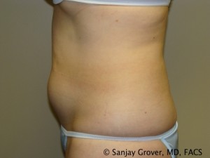 Tummy Tuck Before and After 40 | Grover Aesthetics