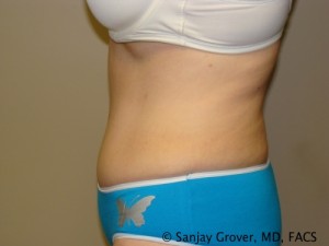 Tummy Tuck Before and After 40 | Grover Aesthetics