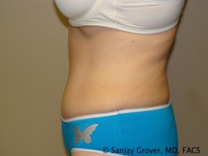 Tummy Tuck Before and After 40 | Sanjay Grover MD FACS