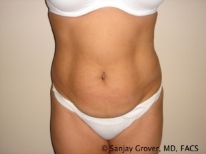Tummy Tuck Before and After 08 | Sanjay Grover MD FACS