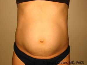 Tummy Tuck Before and After | Grover Aesthetics