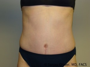 Tummy Tuck Before and After 41 | Sanjay Grover MD FACS