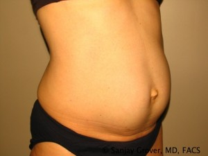 Tummy Tuck Before and After 41 | Sanjay Grover MD FACS