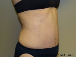 Tummy Tuck Before and After 41 | Sanjay Grover MD FACS