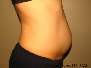 Tummy Tuck Before and After 41 | Grover Aesthetics