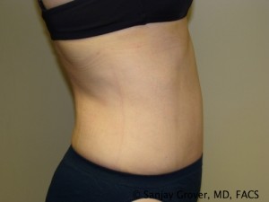 Tummy Tuck Before and After 41 | Grover Aesthetics