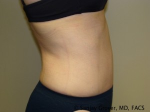 Tummy Tuck Before and After 41 | Sanjay Grover MD FACS