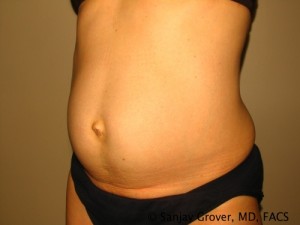 Tummy Tuck Before and After 41 | Sanjay Grover MD FACS