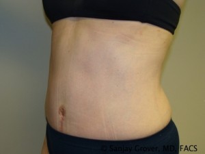 Tummy Tuck Before and After 41 | Sanjay Grover MD FACS