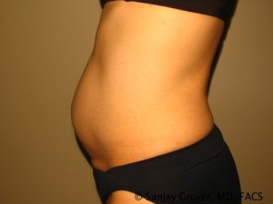 Tummy Tuck Before and After 41 | Grover Aesthetics