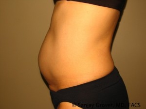 Tummy Tuck Before and After 41 | Sanjay Grover MD FACS