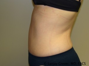 Tummy Tuck Before and After 41 | Sanjay Grover MD FACS