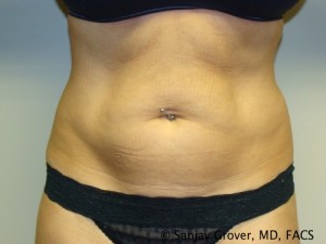 Tummy Tuck Before and After 81 | Sanjay Grover MD FACS
