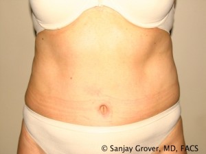 Tummy Tuck Before and After 42 | Sanjay Grover MD FACS