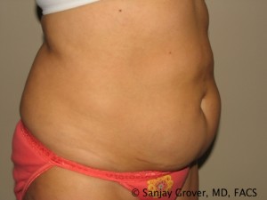 Tummy Tuck Before and After 42 | Sanjay Grover MD FACS