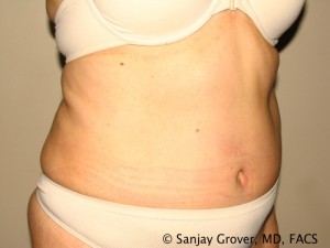 Tummy Tuck Before and After 42 | Sanjay Grover MD FACS