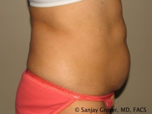 Tummy Tuck Before and After 42 | Sanjay Grover MD FACS