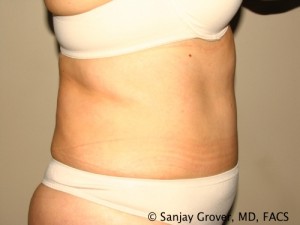 Tummy Tuck Before and After 42 | Sanjay Grover MD FACS