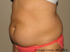 Tummy Tuck Before and After 42 | Sanjay Grover MD FACS