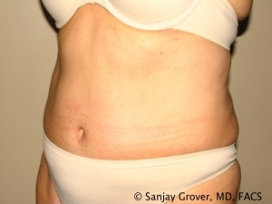 Tummy Tuck Before and After 42 | Grover Aesthetics