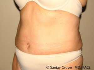 Tummy Tuck Before and After 42 | Sanjay Grover MD FACS