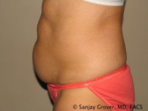 Tummy Tuck Before and After 42 | Grover Aesthetics
