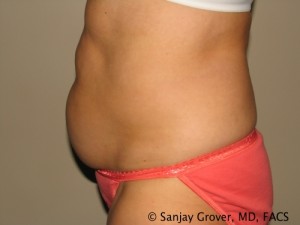 Tummy Tuck Before and After 42 | Sanjay Grover MD FACS