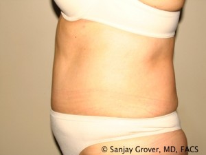 Tummy Tuck Before and After 42 | Grover Aesthetics