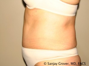 Tummy Tuck Before and After 42 | Sanjay Grover MD FACS